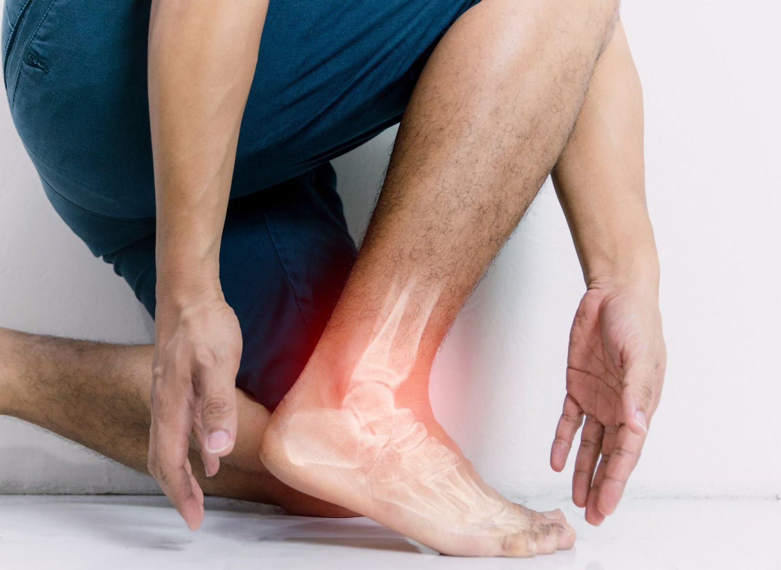 Gót chân bị sưng tấy, minh họa tình trạng viêm gân Achilles do chạy bộ không mang giày sai cách