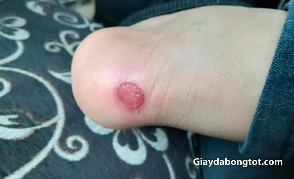 Bạn có thể bị xước gót chân khi mang giày mới do chân chưa kịp làm quen với giày