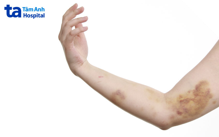 Vết bầm tím trên da